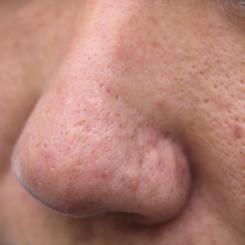 自分の血液で！？ほうれい線がなくなります。目黒駅前アキクリニック