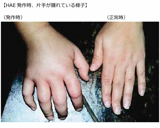 HAEの主な症状-遺伝性血管性浮腫 HAE についてタクザイロ®情報サイト-患者さん・ご家族の方向け武田薬品工業