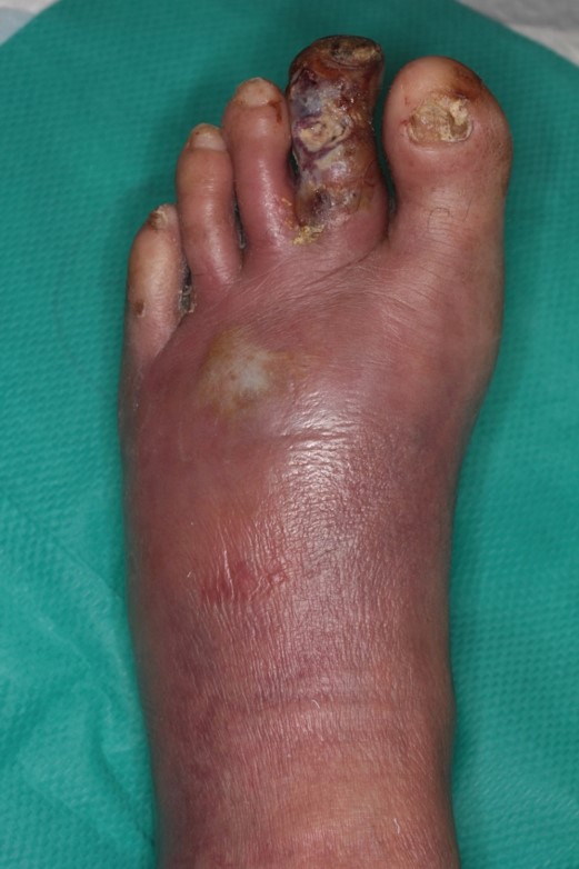 気になるむくみと糖尿病に関して知っておきたい症状と治療法とは