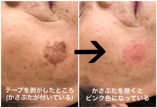 シミ取りレーザー治療特集品川スキンクリニック 公式