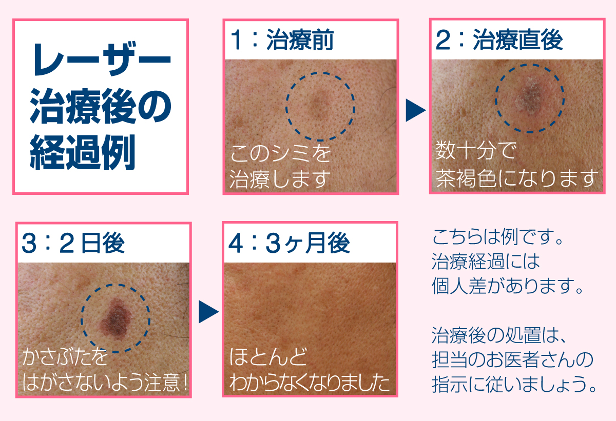 症例写真ポイントのシミ取りにおすすめ「ピコシュア」の経過肌と歯のクリニック 東京ベイ幕張千葉 美容皮膚科