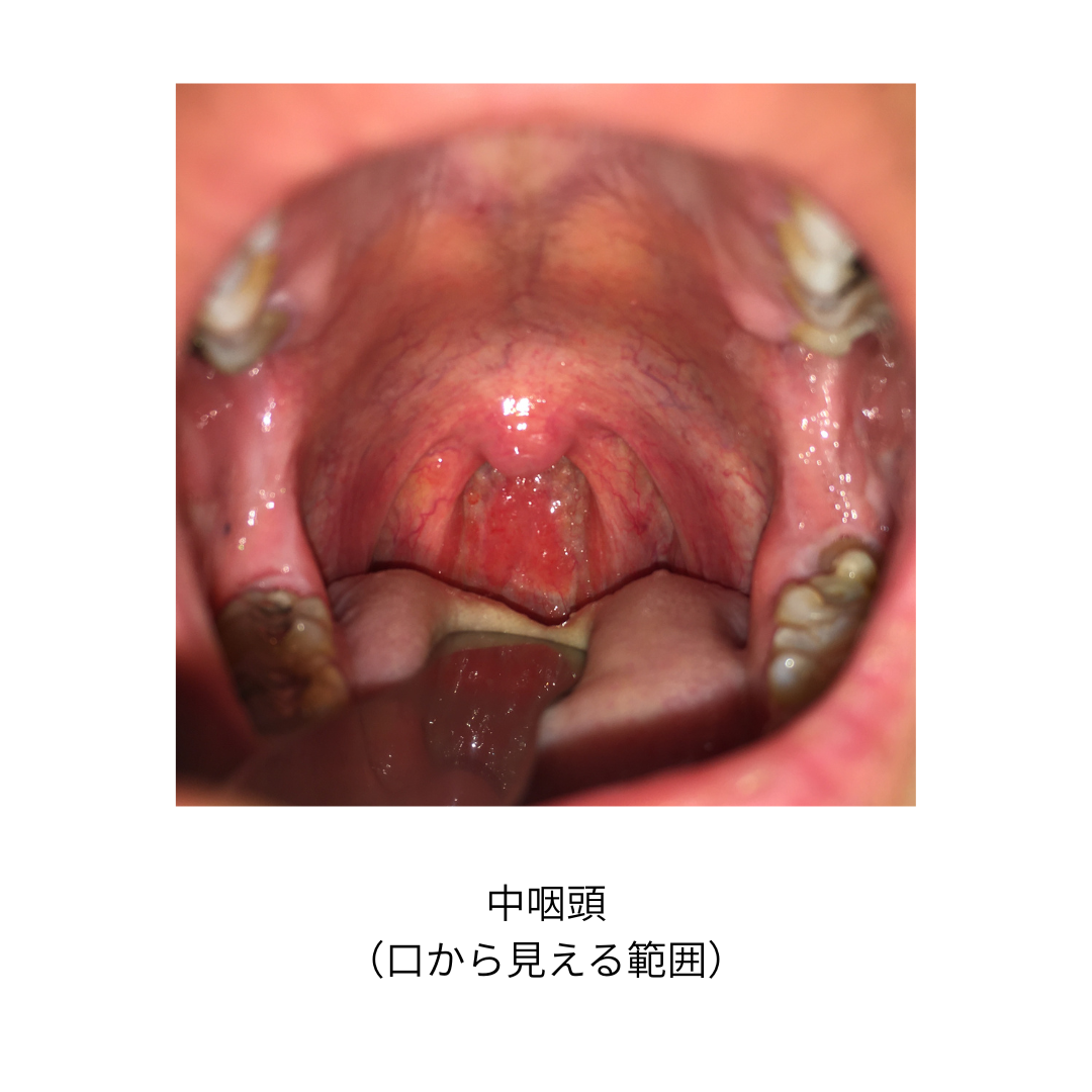 3,900点を超える扁桃炎のストックフォト、写真、そしてロイヤリティフリーの画像 - iStock