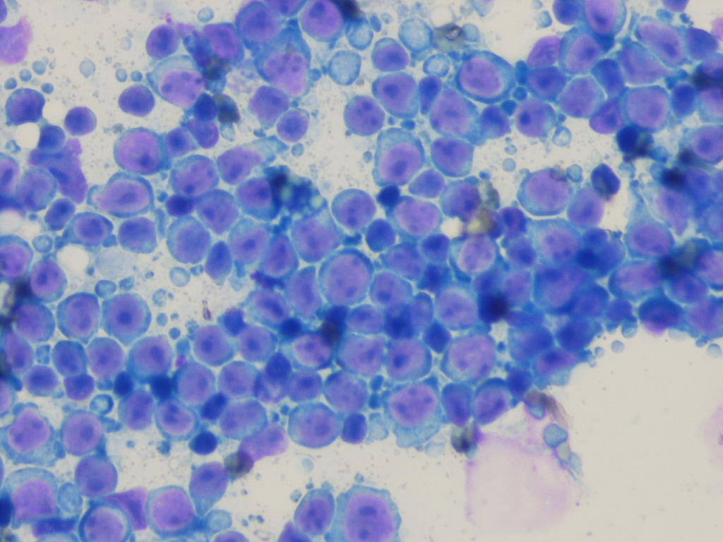 17 Bリンパ芽球性白血病 リンパ腫 B-ALL LBL検査と技術 43巻10号医書.jp