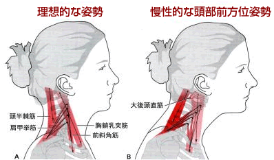 首が前に出る姿勢 ストレートネック の原因は？ストレッチや筋トレでの治し方を解説 - 株式会社リハサク