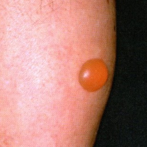 ブヨ ブユ による虫さされの予防策＆対処法は？薬局・薬店で相談できる皮膚トラブルヒフシルワカル