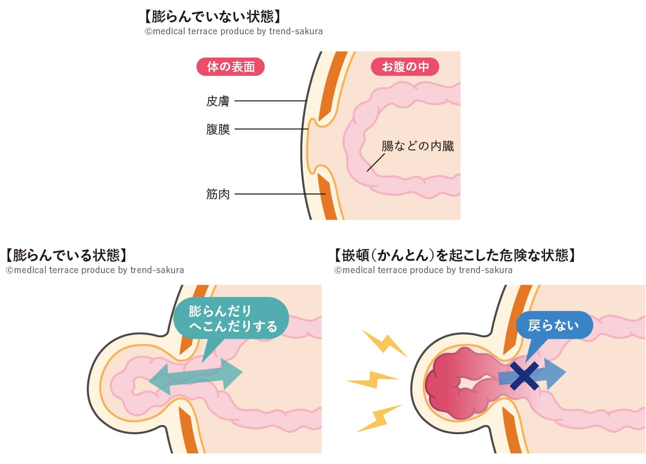 生理的臍帯ヘルニアでした 妊娠期間振り返りアラサーひよっこママの毎日