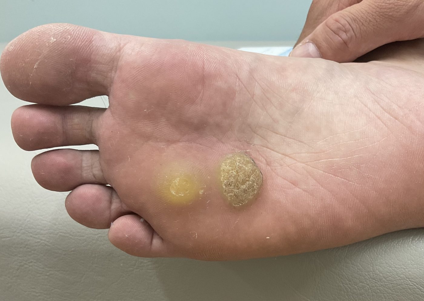 ウイルス性イボ尋常性疣贅- 上野御徒町ファラド皮膚科