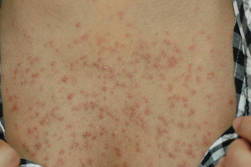 マラセチア毛包炎～胸、肩、背中にニキビ？ 東京警察病院 五十棲健部長 ～トピックス時事メディカル時事通信の医療ニュースサイト