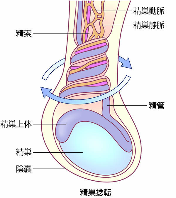 精索捻転症せいさくねんてんしょう とは済生会