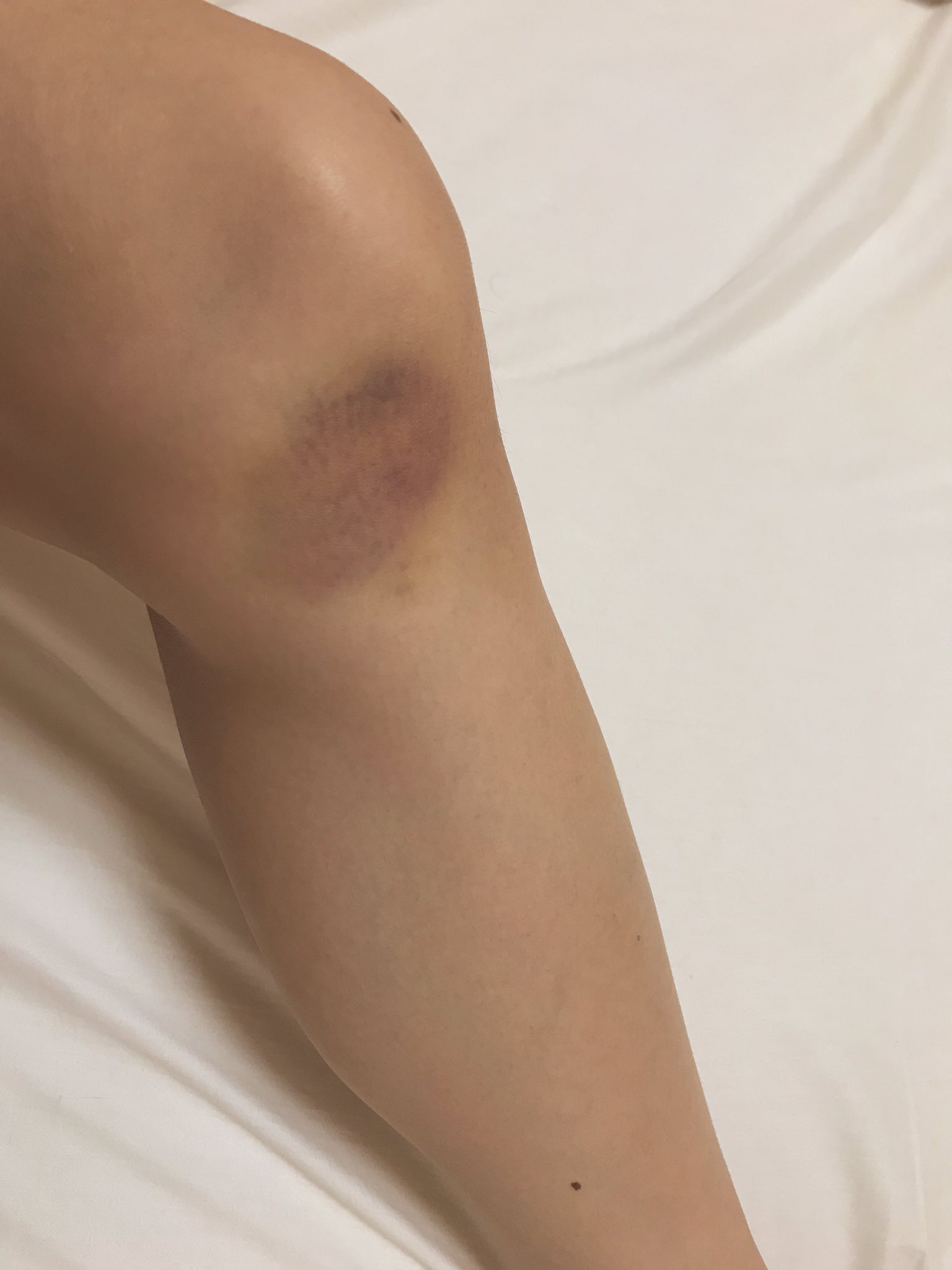 膝のたんこぶ・その後木馬の四方山ばなし