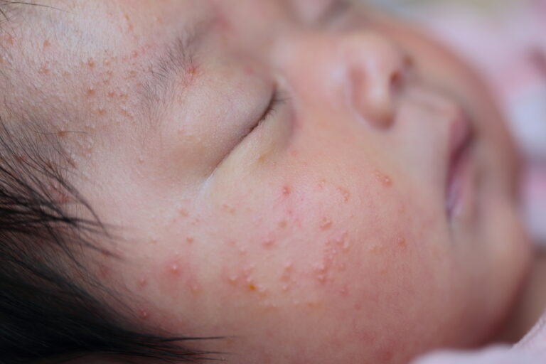 あせも 汗疹 は顔にもできる？花小金井駅前スキンクリニック小平市の皮膚科