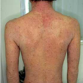 乾癬・アトピー性皮膚炎の治療梅島駅のみずき皮膚科クリニック