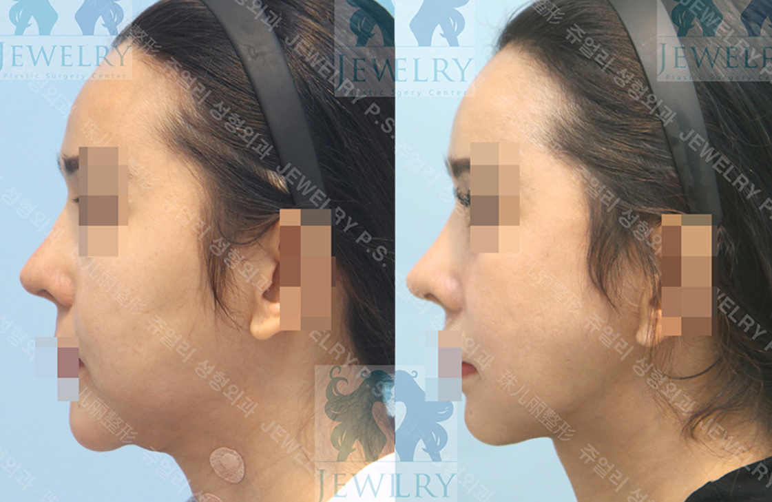 Girl's Dayヘリ整形前後写真楽しく体験する韓国♪チューのブログ