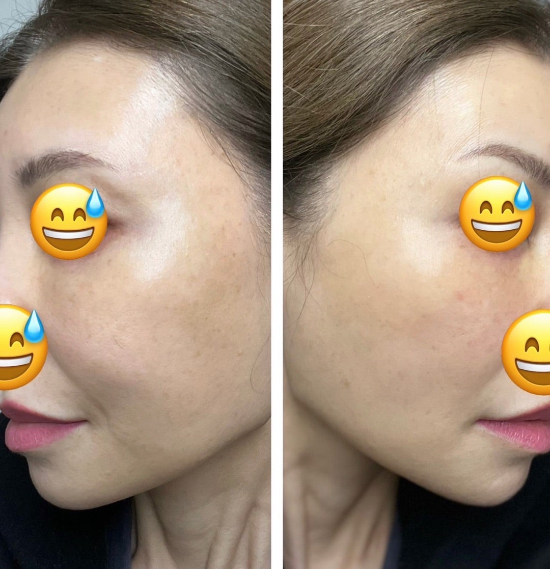 ビフォーアフター有サブシジョンの効果・ダウンタイムとは│SELECT CLINIC TIPS