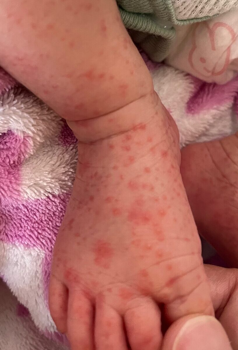 乳児に起こる湿疹 乳児湿疹原因・症状・治療法⾚ちゃん・⼦どもの肌トラブル情報館池田模範堂