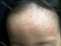 紅色汗疹の写真素材 - PIXTA