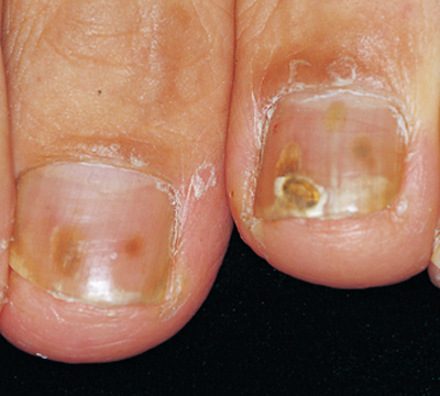 爪囲炎吹田市の皮膚科もりはら皮ふ科クリニック