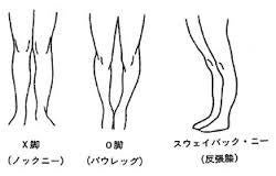反張膝を改善する為に重要なふくらはぎへのアプローチ３選 –名古屋・金山でパーソナルトレーニング 女性・ダイエット 猫背・腰痛・姿勢なら「sun-arch」へ