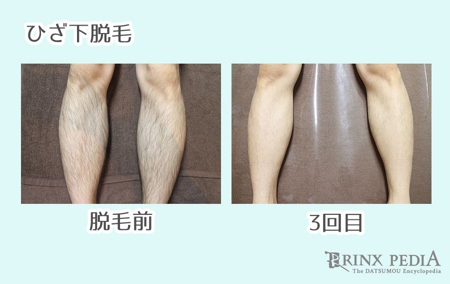 足の脱毛 ならメンズ脱毛☆アダムワン☆ – ADM ONE BLOG