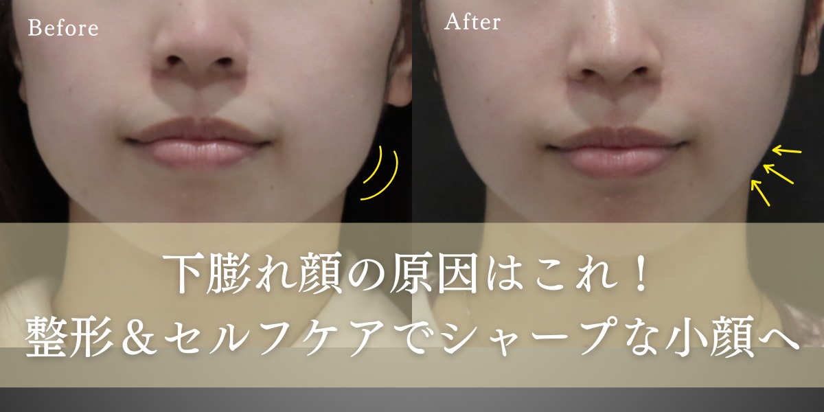 頬骨骨切り・骨削り・縮小頬骨整形・小顔・顔痩せ池袋の美容皮膚科・美容外科ならみずほクリニック