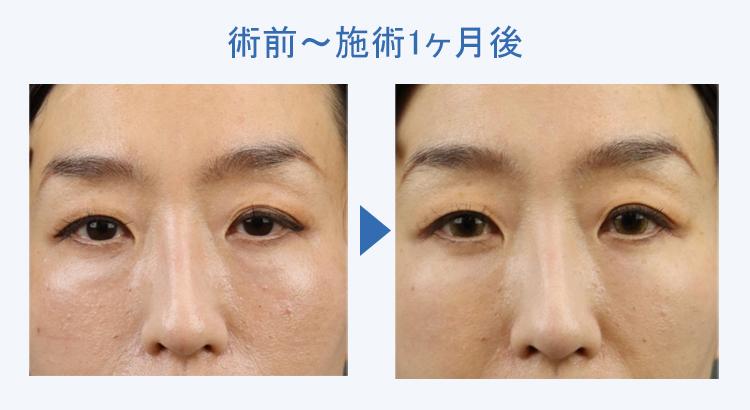 眼輪筋を鍛えるトレーニングとマッサージをプロが伝授！衰える原因も解説│看護師ライフをもっとステキに ナースプラス