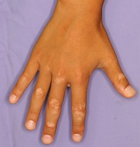 写真でみる尋常性白斑－原因や治療指針、研究の最前線について専門家が詳しく解説メディカルノート