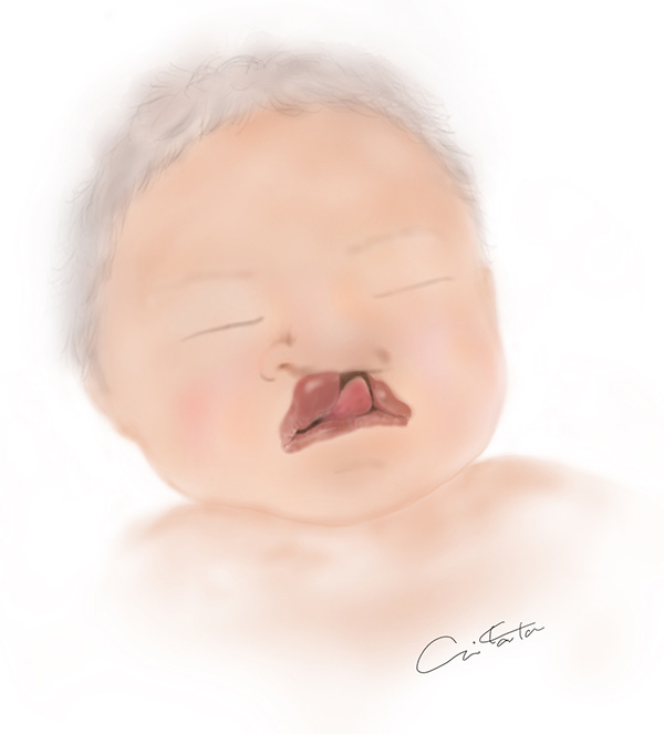 口唇口蓋裂＞「怖かった」手術を明日に控えた娘が本音をポツリ。会話から成長を感じて ウーマンエキサイト