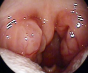 扁桃のラジオ波手術・笠井耳鼻咽喉科クリニック