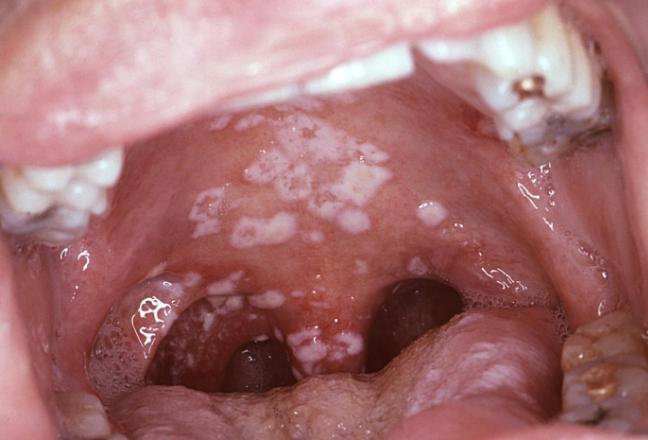 大きい口内炎ができた！その正体や原因、対処法を解説