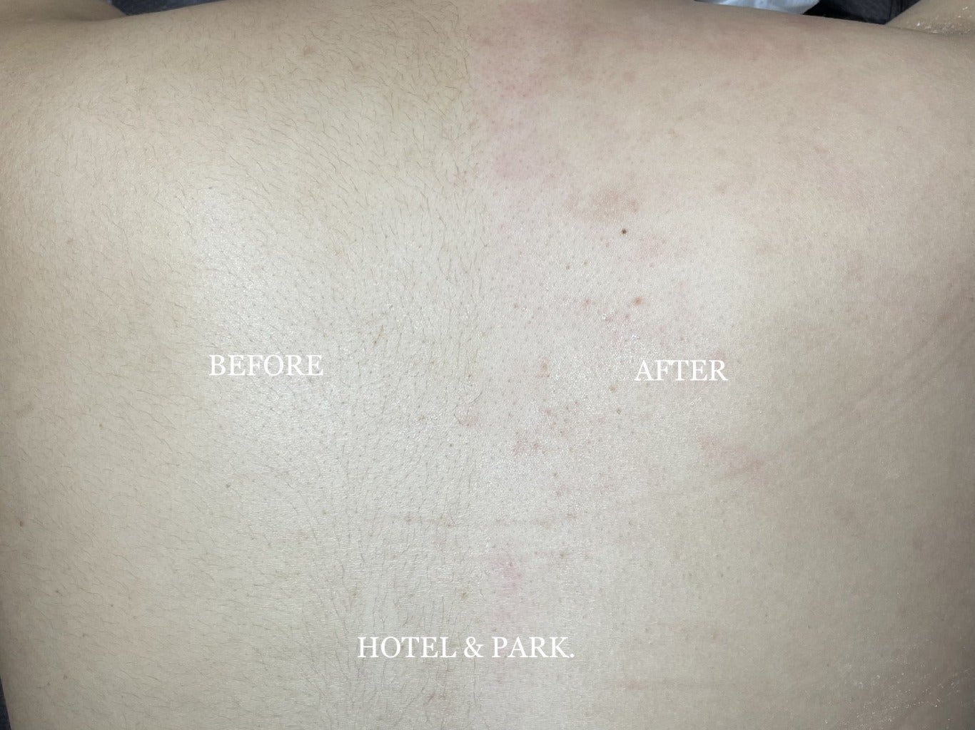 お悩みの女性が多い毛穴詰まり 角栓・角化症 の改善例美保薬局福島県いわき市の皮膚病お悩み相談専門の経験豊富な薬局です