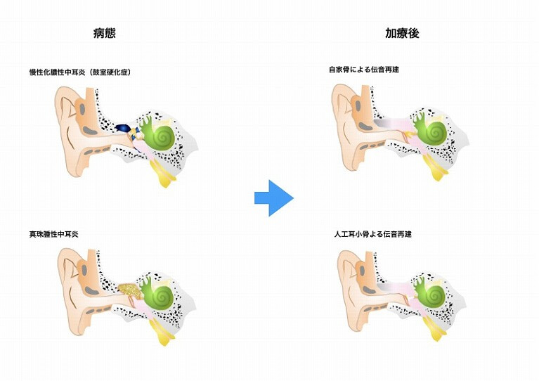 骨伝導補聴器とは 仕組みや効果、向いている人を解説