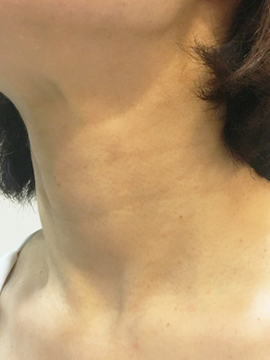 妊娠中にできた首のイボ ぽつぽつ の原因は？綺麗にとる方法６選 – IKURICH いくリッチ育児ママの毎日をちょっと豊かに