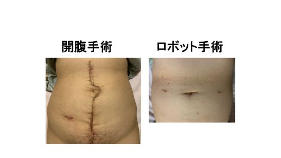 手術療法治療法子宮筋腫note