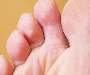 帯状疱疹について郡山つつみ鍼灸整骨院