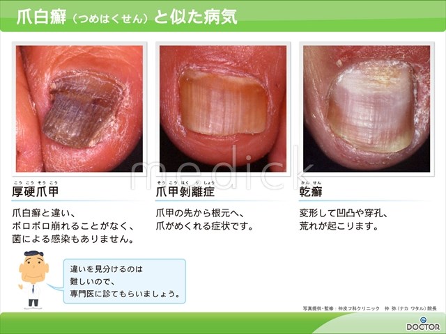 爪が厚くなり変形する病気、肥厚爪 爪甲鉤彎症 について