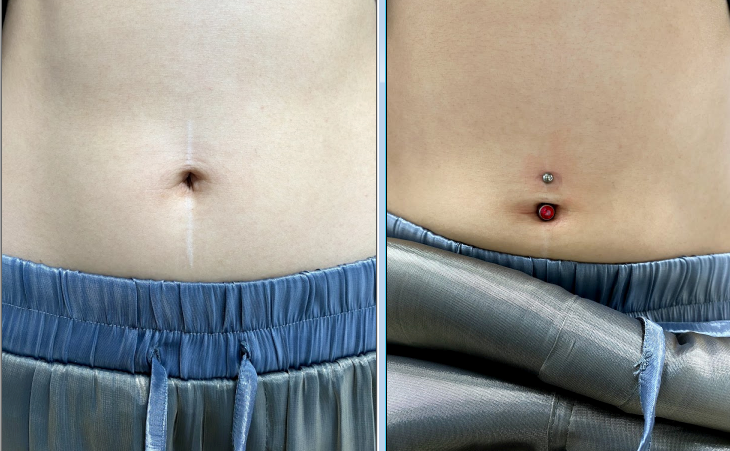 今すぐチェック！おへその形で分かる、あなたの「下がり腸」レベル