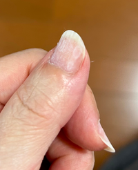 巻き爪・陥入爪・爪の病気の治療法 爪の色や形からわかる臓器の疾患5ページ目 ：働くオンナの保健室：日経Gooday グッデイ