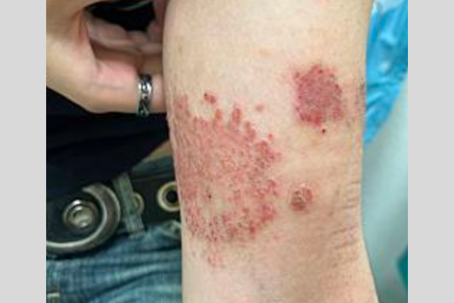 乾癬と間違いやすい疾患かゆみナビ