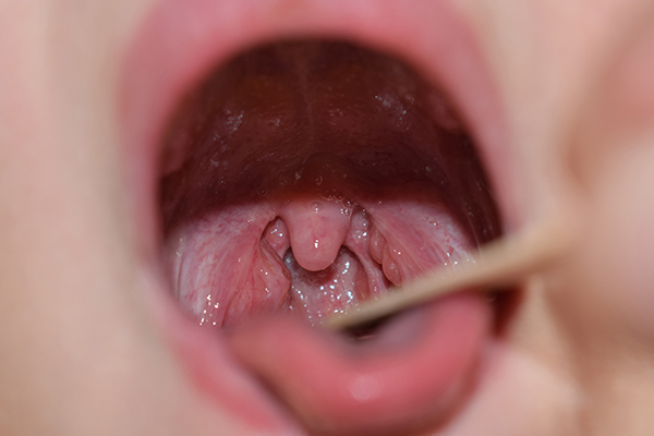 口腔・咽頭の病気一般社団法人 日本耳鼻咽喉科頭頸部外科学会