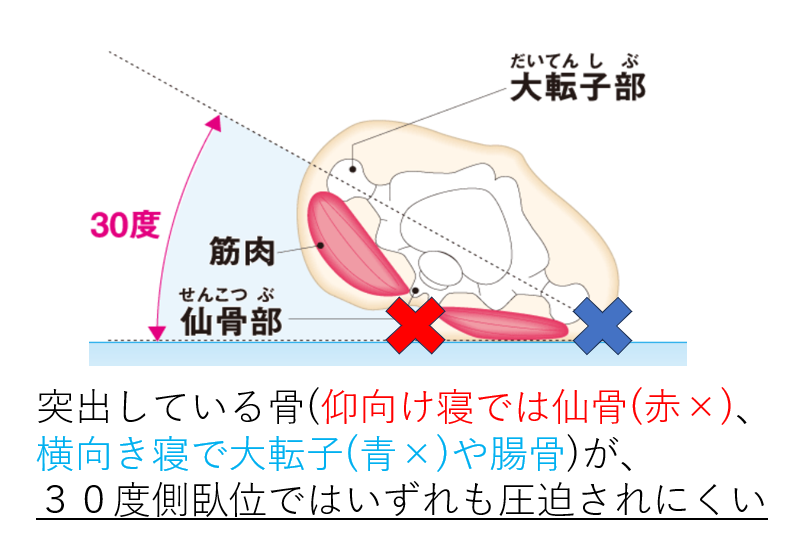 褥瘡 床ずれ とは？ 原因と症状、予防法についてHeartPlus ハートプラス