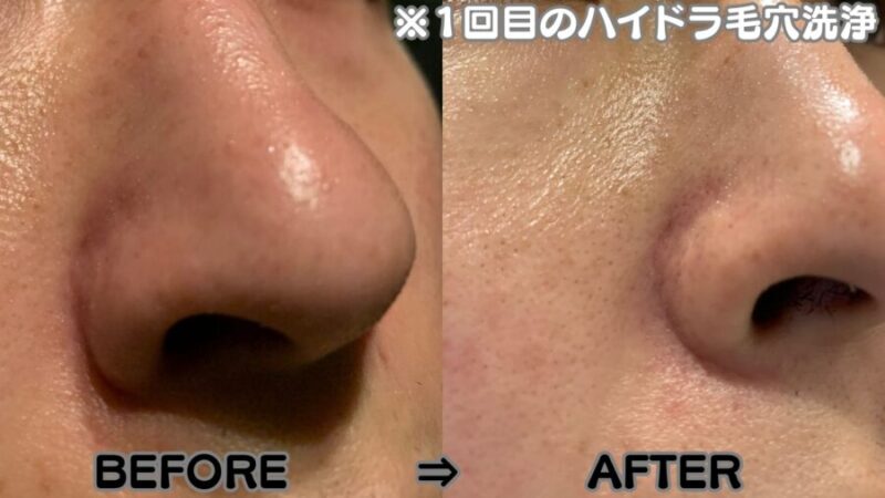 メンズの毛穴の黒ずみ・開き治療 男性専門ゴリラクリニック