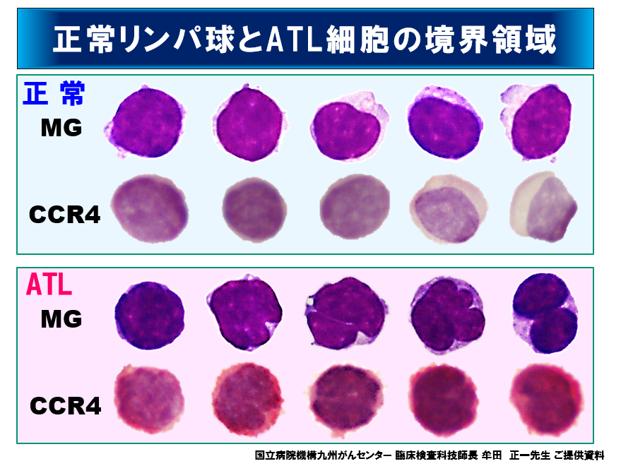 慢性リンパ芽球性白血病CLLを示す顕微鏡下の血液塗抹標本Premium写真
