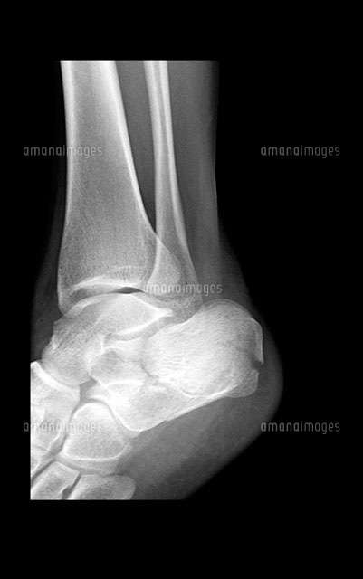 足首の骨端線損傷 下腿遠位端骨端線損傷
