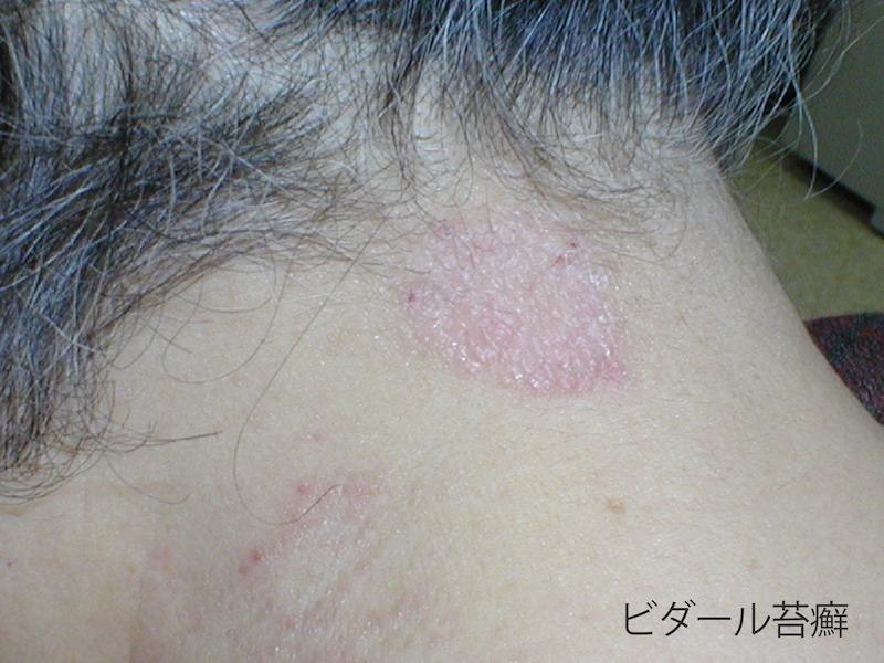 湿疹・皮膚炎気になる皮膚症状を調べる│マルホ株式会社皮膚_部位・症状 疾患検索