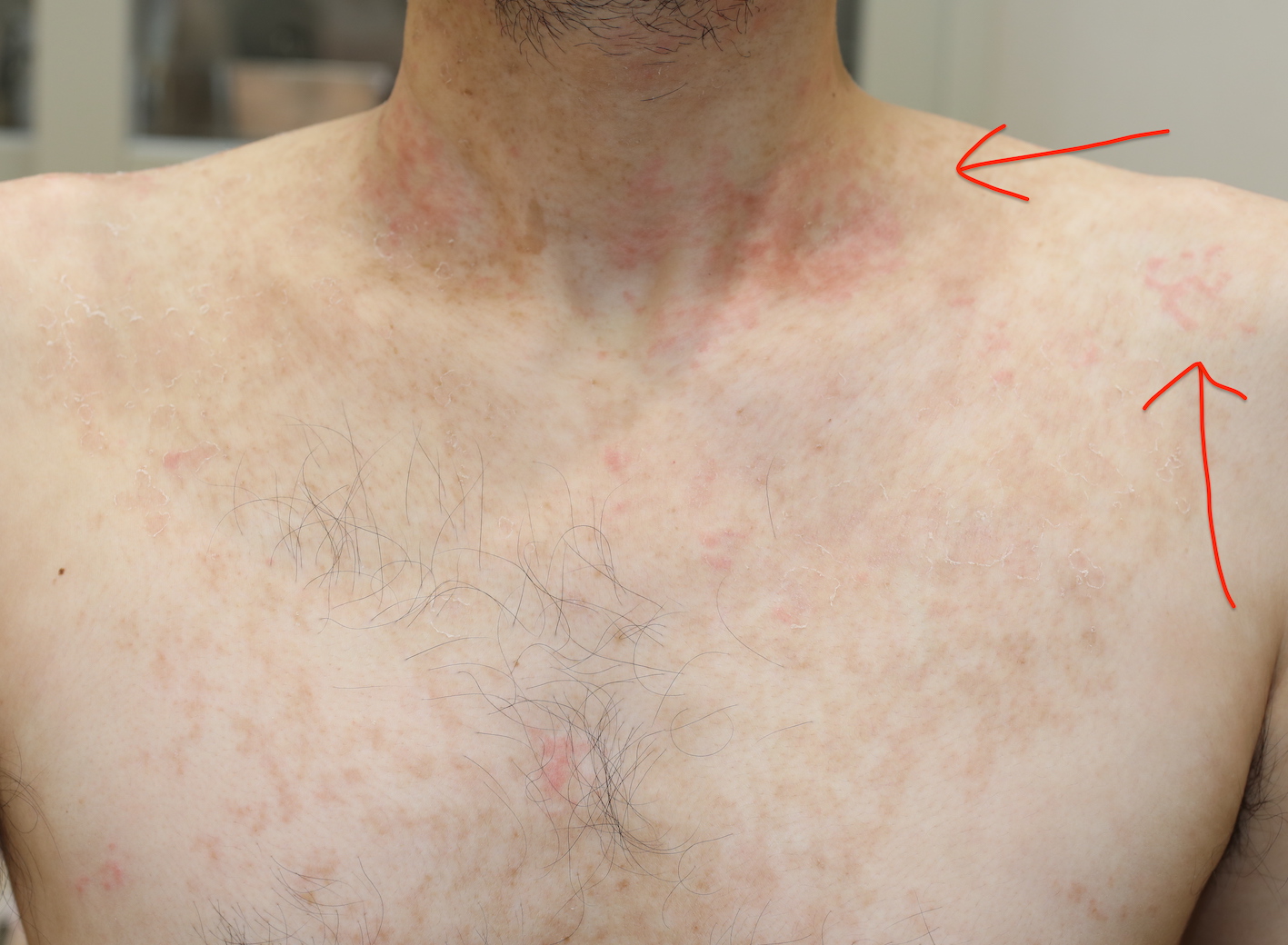 胸ニキビの原因と治し方は？予防法や似た病気との見分け方も解説ハダメディア by BIHADADO.TOKYO