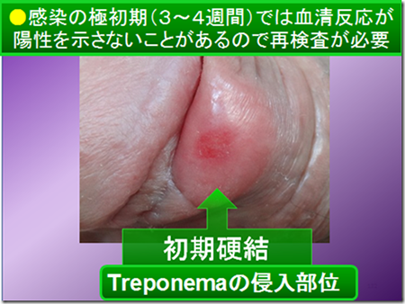 梅毒梅毒、性感染症 STI ①看護roo! カンゴルー