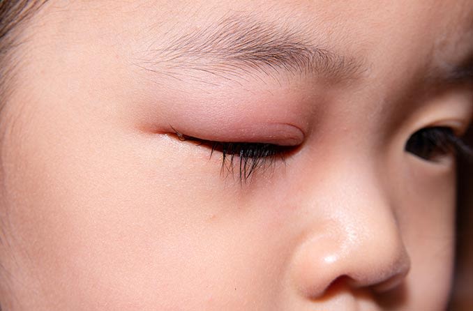 まぶたが腫れる - 足立区・北綾瀬で眼科をお探しなら北あやせよつば眼科