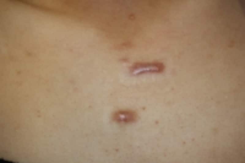 胸ニキビの原因と治し方は？予防法や似た病気との見分け方も解説ハダメディア by BIHADADO.TOKYO