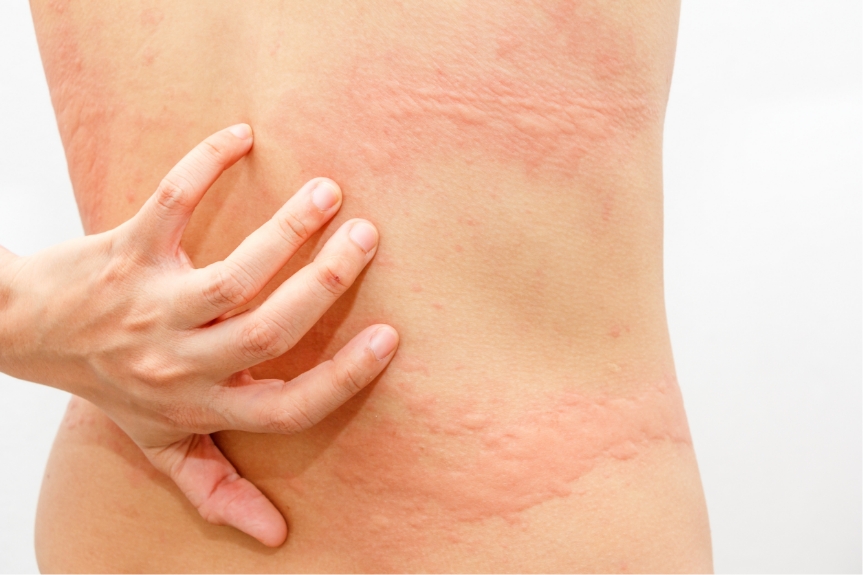 蕁麻疹 じんましん 皮膚科なら明治通りクリニック 東京 渋谷