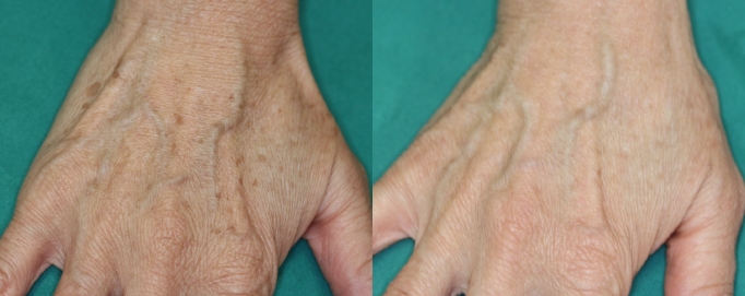 北村理子クリニック皮ふ形成外科ブログ手の甲のシミ。60代女性